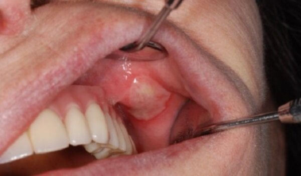 Медикаментозный стоматит с локализацией на нижней губе