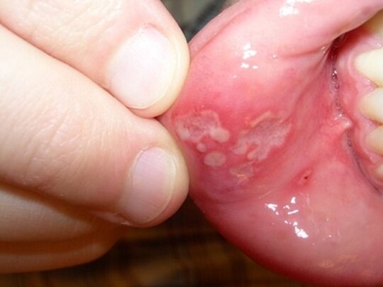 Медикаментозный стоматит с локализацией на нижней губе