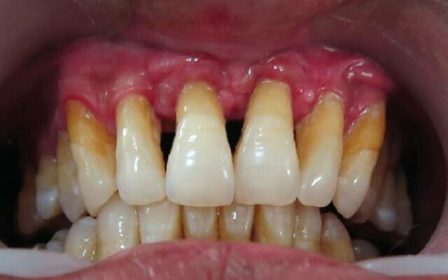 Пародонтит зуба сколько стоит лечение thumbnail