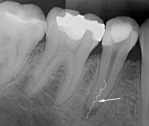 Инородное тело при лечении зубов