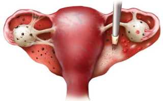 Лечение диффузного эндометриоза матки
