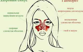 Гайморит у взрослых: симптомы и лечение в домашних условиях