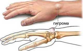 Гигрома – есть ли риск развития злокачественной опухоли?
