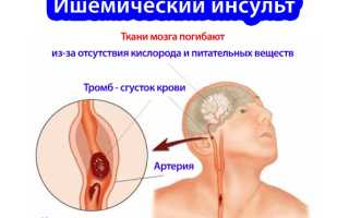 Ишемический инсульт головного мозга: симптомы, лечение и восстановление