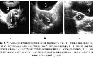 Причины и последствия отклонения матки