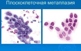 Плоскоклеточная метаплазия шейки матки что это такое