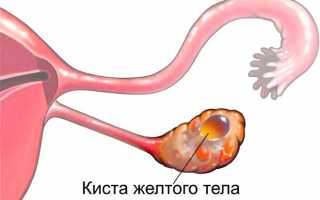 Почему образуется киста желтого тела яичника