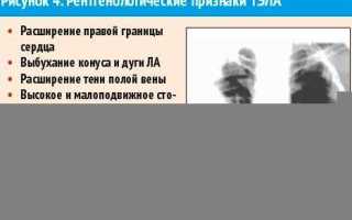 Тромбообразования  в легких: симптоматика и опасность