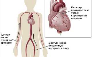 Как и для чего проводится коронарография сердца?