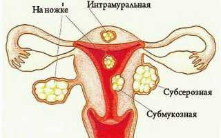 Субсерозный миоматозный узел матки