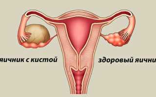 Форум о кисте яичника — отзывы о том, как лечат кисту яичника без операции