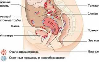 Лечение эндометриоза брюшины малого таза