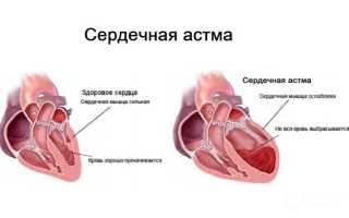 Основные причины сердечной астмы, оказание первой помощи