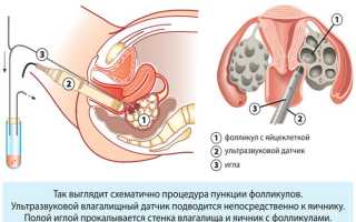 Как избежать гиперстимуляции яичников при ЭКО — лечение патологии