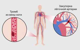 Тромбоз легочной артерии, суть заболевания, симптоматика и терапия