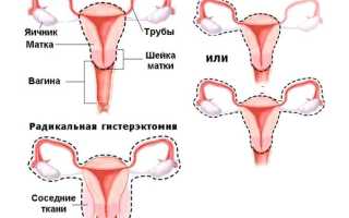 Последствия жизни без матки в 40 лет