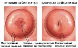 Эрозия шейки матки и эктропион что это