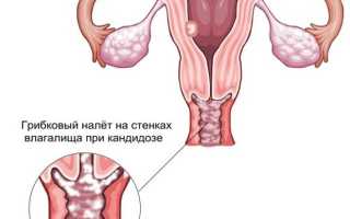 Как вылечить хроническую молочницу (кандидоз) у женщин