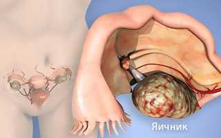 Опухолевидные образования яичников — классификация, эффективная терапия и прогноз