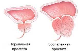 Состав и способы применения Простодина при простатите