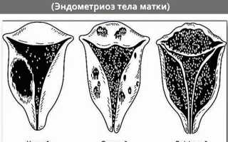 Как вылечить аденомиоз матки в домашних условиях — эффективные методы