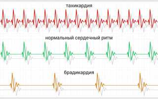Опасно ли высокое давление при слабом сердечном ритме?