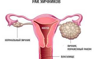 Признаки рака яичников у женщин и первые симптомы заболевания