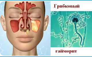 Грибковый гайморит опасное поражение слизистой.