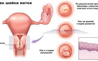 Первые признаки рака матки на ранней стадии