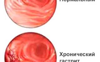 Хронический гастрит симптомы и лечение