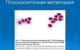 Что это такое плоскоклеточная метаплазия