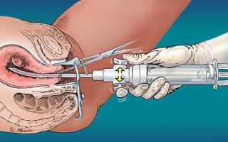 Вакуумная аспирация содержимого полости матки