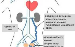 Особенности проявления расширение вен малого таза у женщин