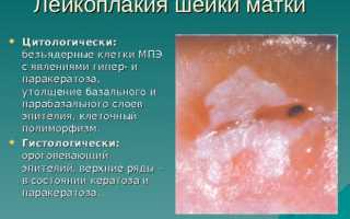Простая и очаговая лейкоплакия шейки матки