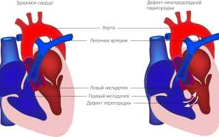 Причины возникновения и особенности лечения дефекта межпредсердной перегородки