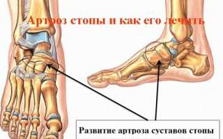 Артроз стопы: симптомы и лечение