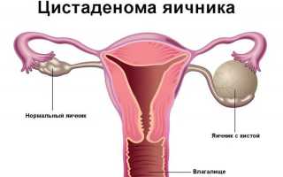 Классификация цистаденомы яичника — оперативное вмешательство и прогноз