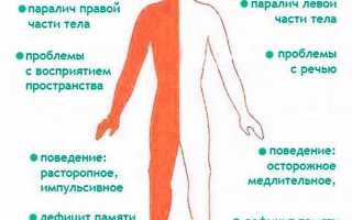Понятие инсульта спинного мозга