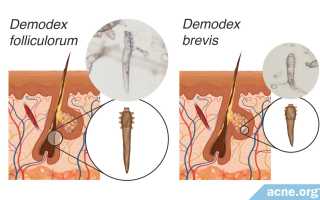 Клещ Demodex Folliculorum (железница угревая): описание, цикл развития и методы лечения