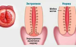 Эрозированный эктропион шейки матки