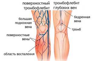 Тромбофлебит глубоких вен на ногах: симптоматика, варианты лечения и профилактика