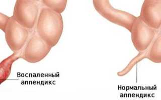 Признаки аппендицита у женщин: 9 главных симптомов
