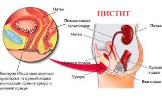 Цистит у женщин: симптомы и лечение