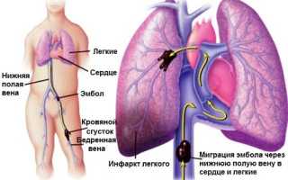 Чем грозит тромбоз нижней полой вены?