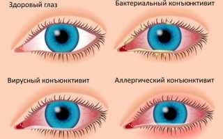 Вирусный конъюнктивит: симптомы и лечение у взрослых