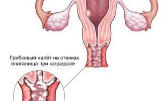 Гигиена при молочнице у женщин