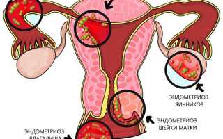 Негормональное лечение эндометриоза если противопоказана гормонотерапия