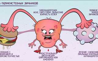 Методы лечения кисты яичника в домашних условиях