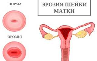 Причины возникновения эрозии шейки матки