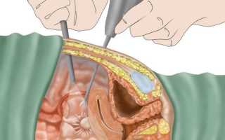 Лечение и профилактика эндометриоза после лапароскопии
